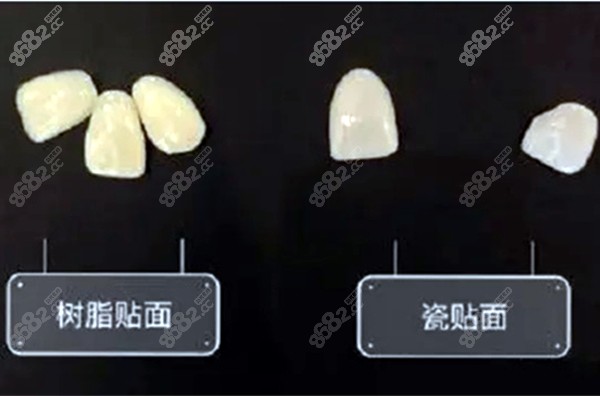 树脂贴面和瓷贴面的图