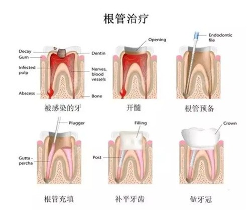 牙神经烂掉后要怎么处理才好