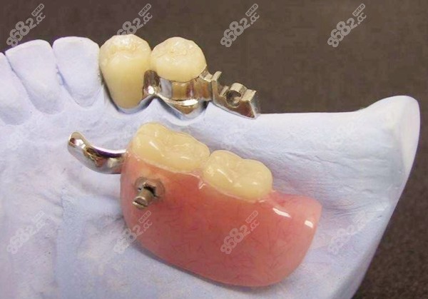 门牙拔后临时假牙照片图片