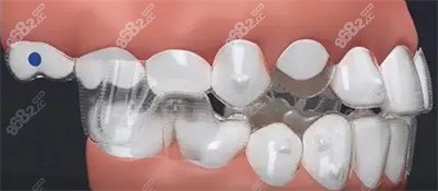 可丽尔隐形牙套的特点及优势1 可丽尔隐形牙套的特点及优势1