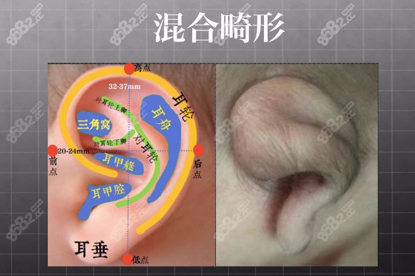 小耳畸形修复手术