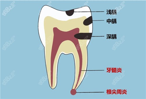 牙神经坏了不能进行修复