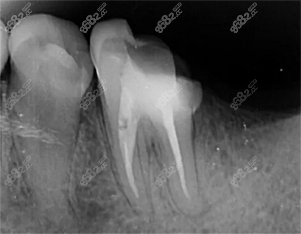 根管治疗20年后牙齿怎么办