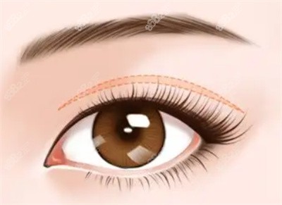 青岛华韩整形在双眼皮手术方面的优势2