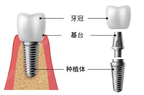 种植牙分解示意图