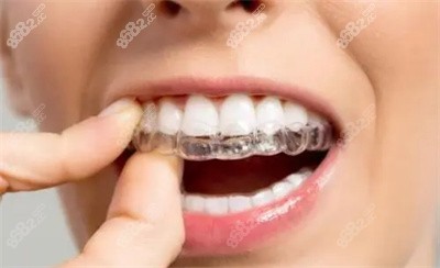 可丽尔隐形牙套的特点及优势2 可丽尔隐形牙套的特点及优势2