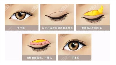 青岛华韩整形在双眼皮手术方面的优势3