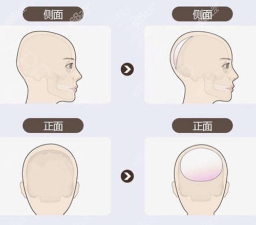 头顶整形模拟图