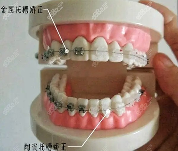 平度矫正牙齿多少钱