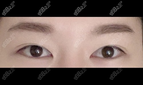 在韩国爱护做双眼皮手术前