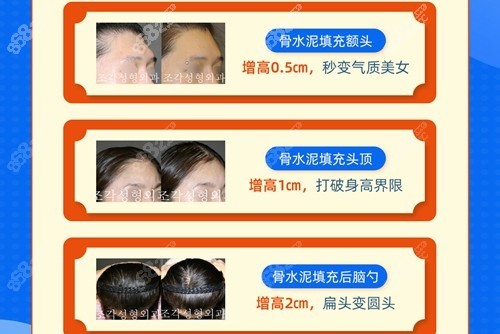 韩国雕刻整形医院做扁头变圆头整形手术反馈