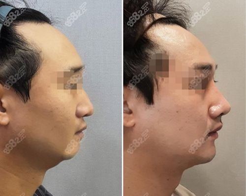 韩国温度韩俊院长做鼻中隔软骨隆鼻术前术后对比照.jpg