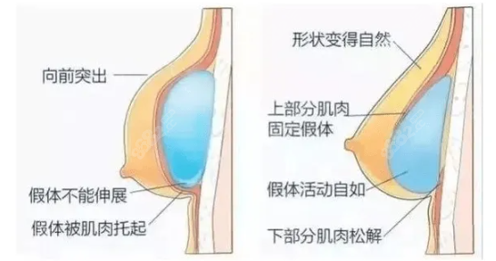 复合隆胸