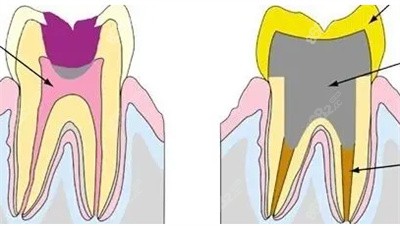 牙槽骨萎缩5