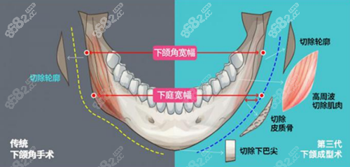 下颌角手术方法