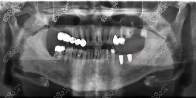 牙槽骨萎缩2