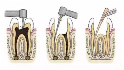 牙龈萎缩2
