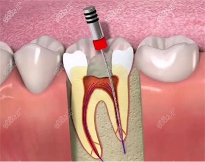 牙龈萎缩3