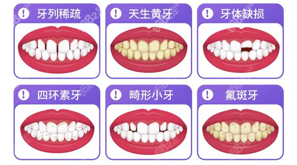 哪些牙齿适合做牙齿贴面