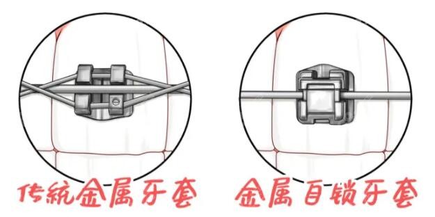 永川金属托槽牙套的价格