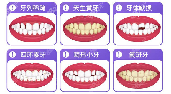 牙齿贴面适合哪些牙齿