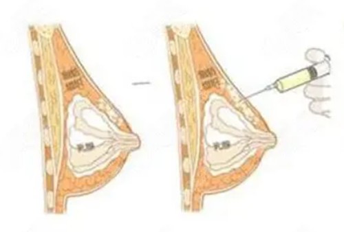 做脂肪丰胸一次可以填充多少