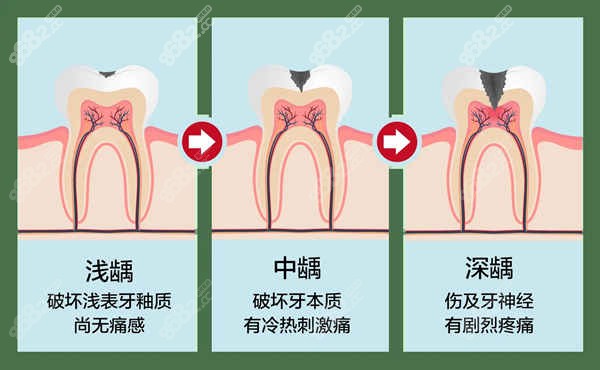 轻微龋齿补牙后悔死了