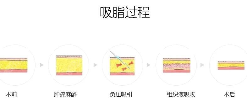 “我150斤抽脂抽了30斤”是不是可信的