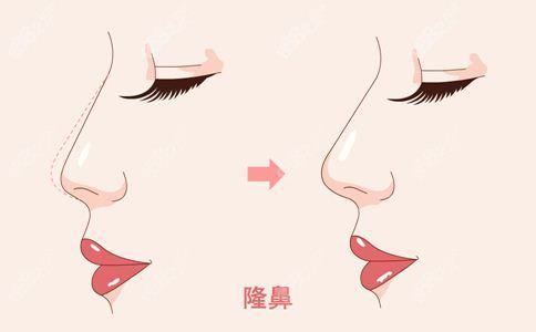 李信锋医生做鼻子手术价格
