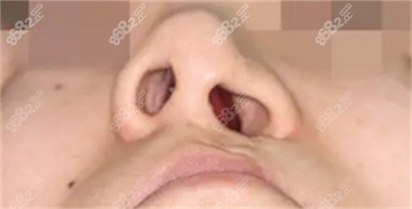 唇腭裂鼻子能变正常吗