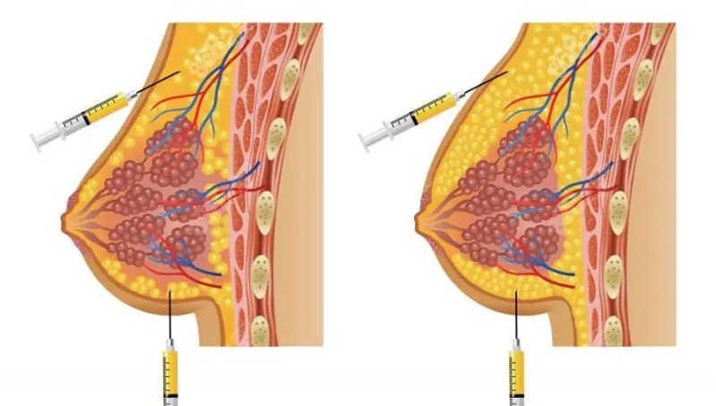 自体脂肪隆胸前后的对比