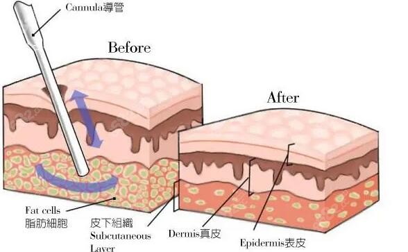 我150斤抽脂抽了30斤