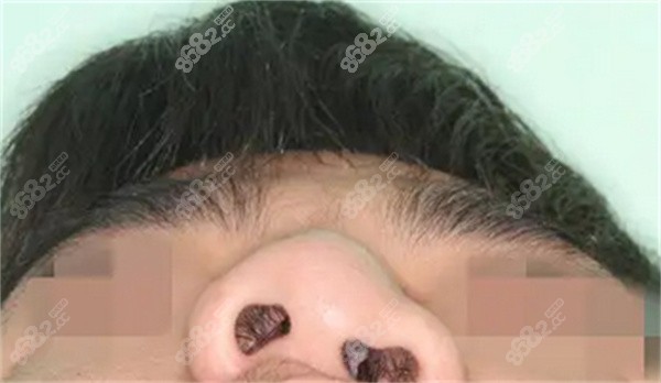 唇腭裂鼻子多大修复？