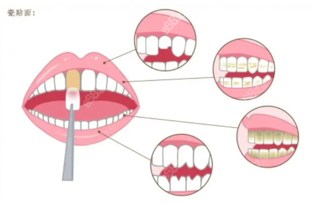 牙齿贴面后如何护理