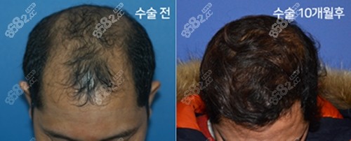 韩国布莱克毛发移植真人实例