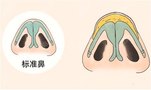李信锋医生鼻失败修复花8万值不值？