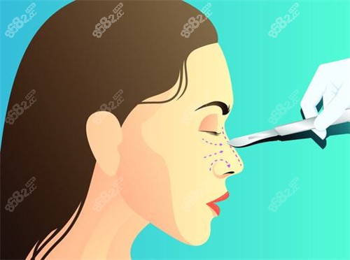 李信锋医生做鼻子手术价格贵吗？