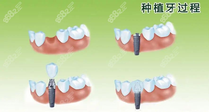 种植牙过程