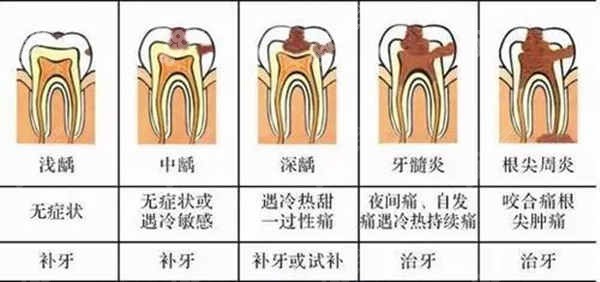 轻微龋齿补牙后悔死了