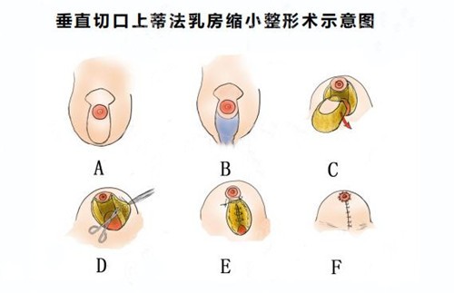 8682cc提供的乳房缩小手术图解