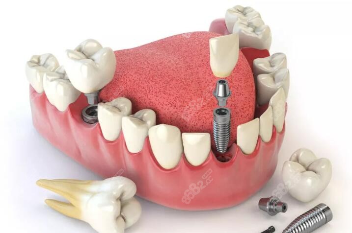 益阳安化口腔种植牙价格表更新