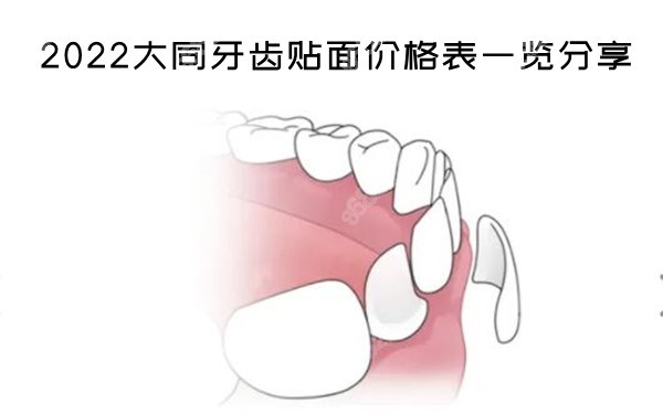 2022大同牙齿贴面价格表一览分享