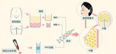 余春国医生做脂肪填充手术的技术优势6