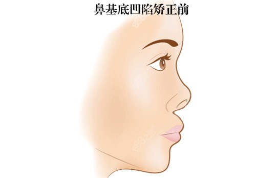 膨体或者是硅胶垫鼻基底总会好许多的