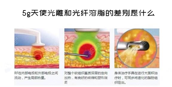 5g天使光雕和光纤溶脂的差别