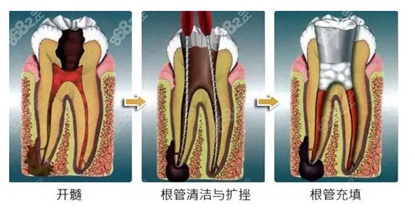 根管治疗后悔一辈子是真的吗