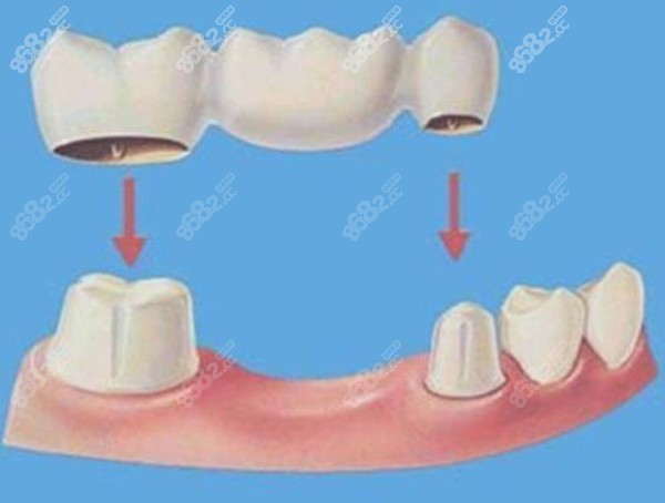 镶牙的优点和缺点