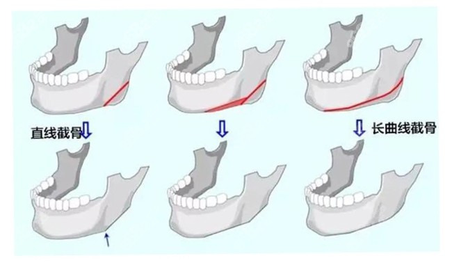 下颌角磨骨手术的原理图