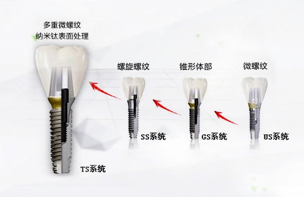 韩国奥齿泰种植牙型号及价格