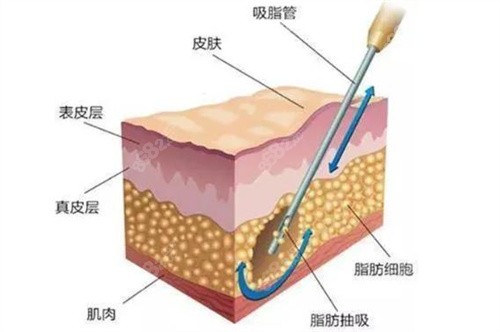 脂肪抽吸层次